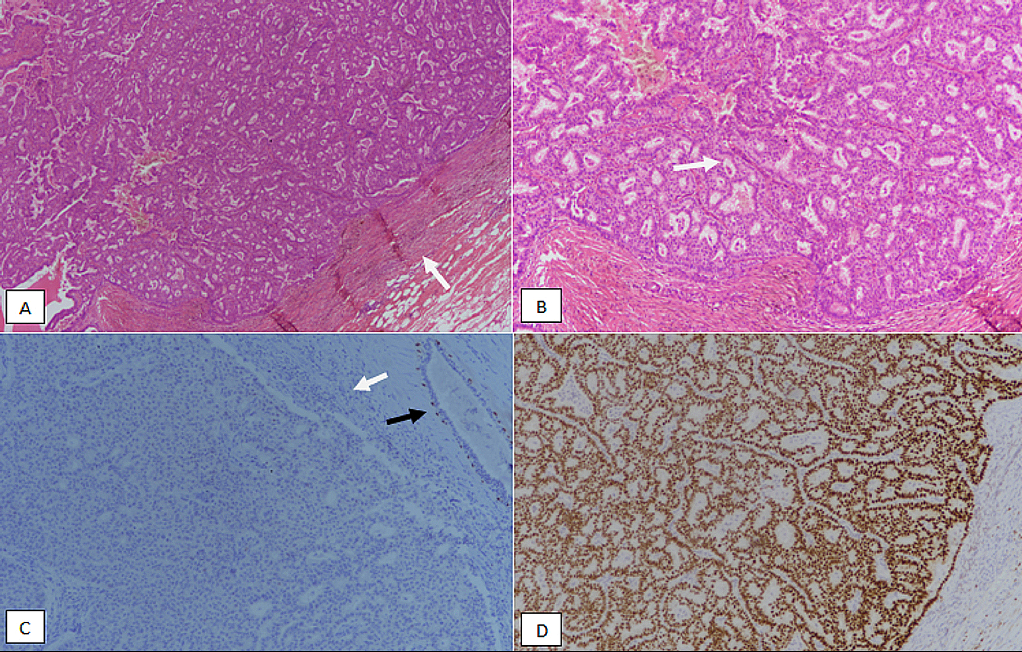 papillary carcinoma