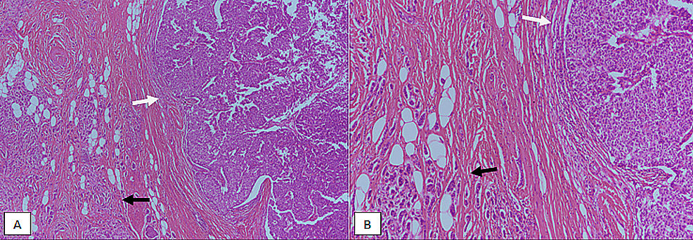 Encapsulated-papillary-carcinoma-(EPC)-with-invasion,-H&E-stained-sections.-(A)-40X-magnification-showing-both-in-situ-(white-arrow)-and-invasive-(black-arrow)-components.-(B)-100X-magnification-showing-EPC-in-situ-with-circumscribed-borders-(white-arrow)-and-invasive-component-resembling-conventional-invasive-ductal-carcinoma-(black-arrow).