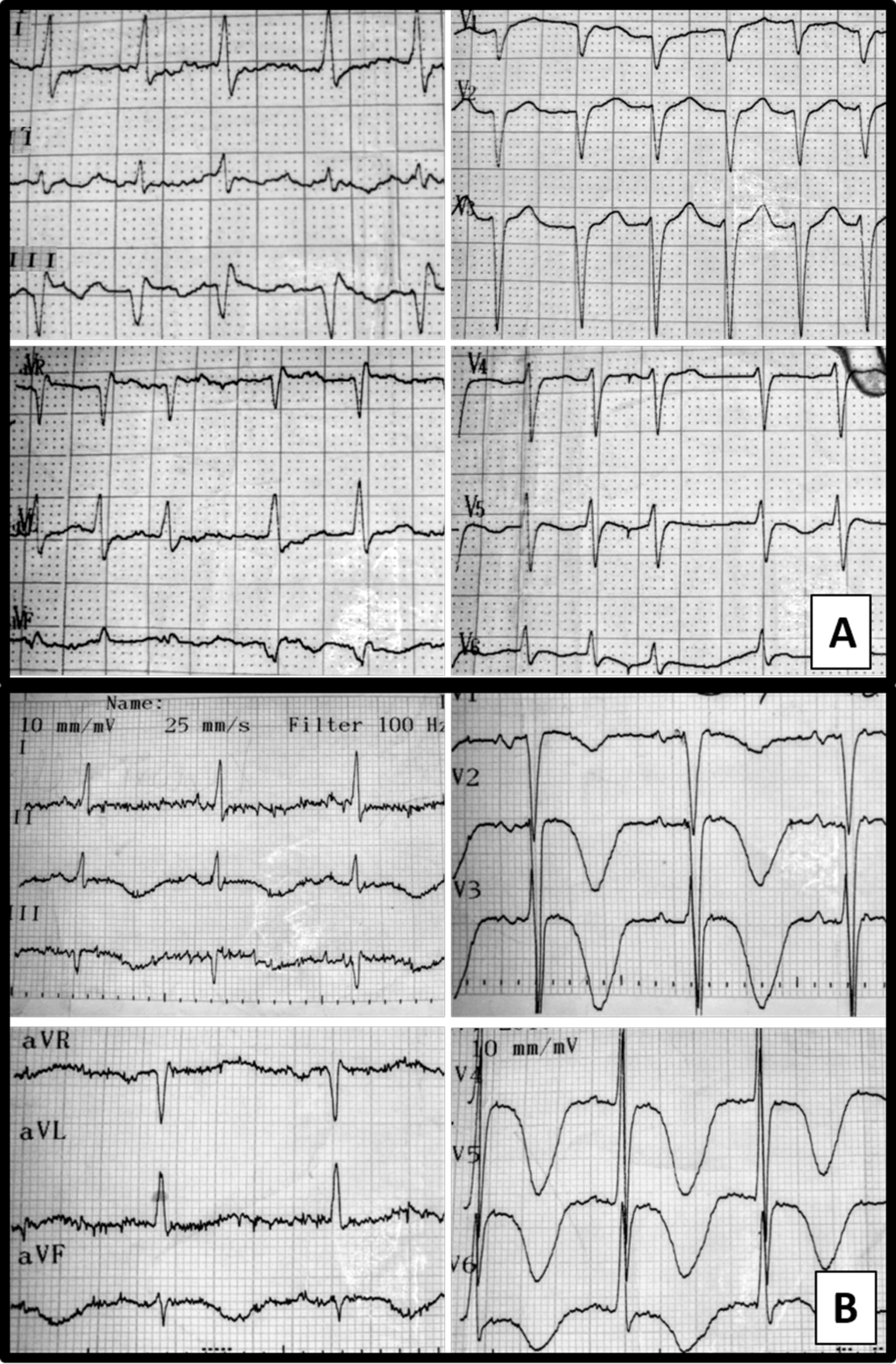 Cureus Torsades De Pointes And Prolonged Self Terminating Ventricular Fibrillation Induced By Amiodarone