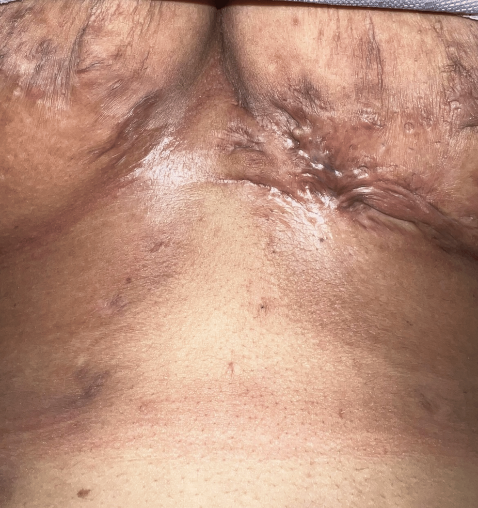 doxycycline and semaglutide reddit Unique Presentation of the Follicular Occlusion Tetrad: A Case Report and  Review of the Literature