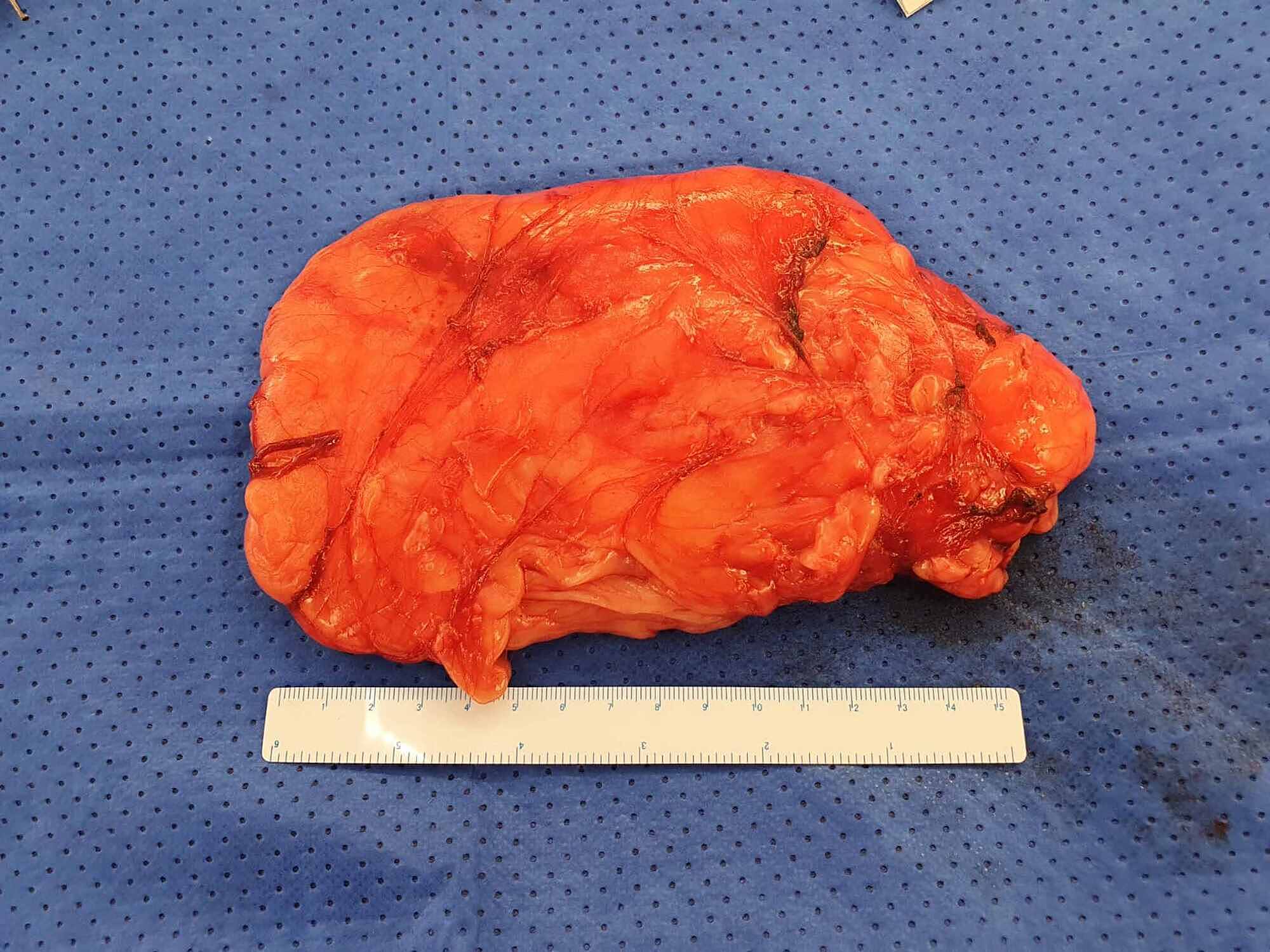 Cureus | Large Intermuscular Lipoma Presenting as a Groin Hernia