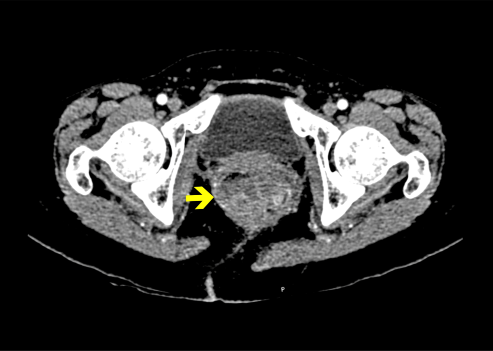 metastatic melanotic peripheral nerve Malignant Peripheral Nerve Sheath Tumor of the Rectum Characterized by  Focal S100 Protein Expression