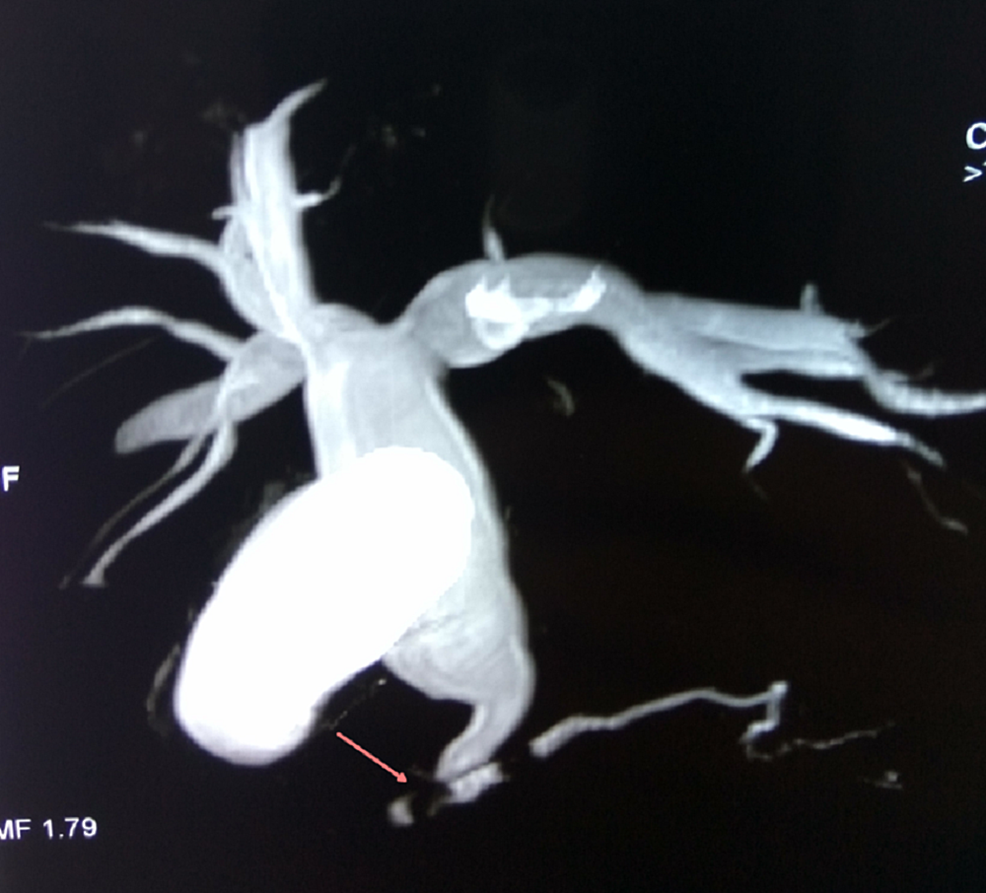 Cureus Choledochal Cyst A Retrospective Study of 30 Cases From Nepal