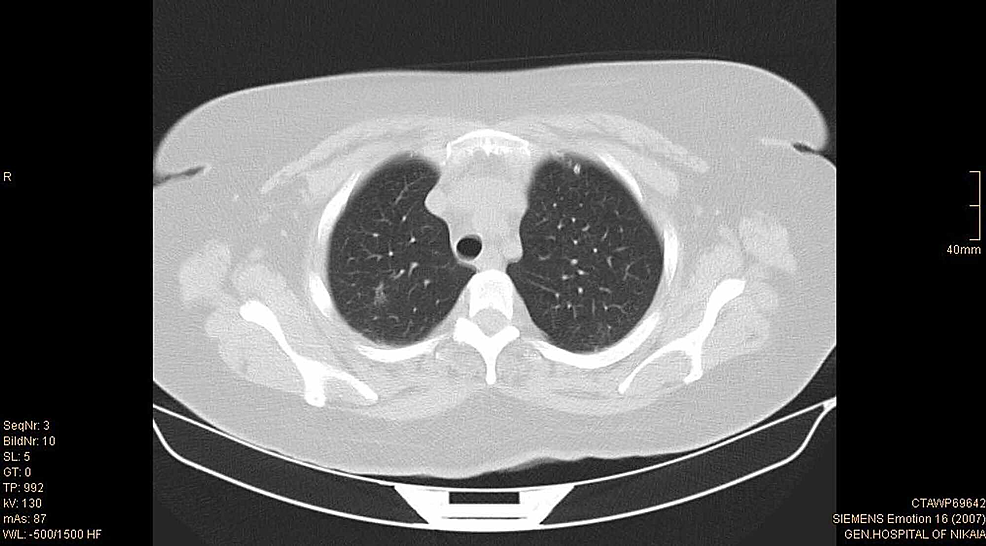 icd-10-code-for-nodule-chest-wall