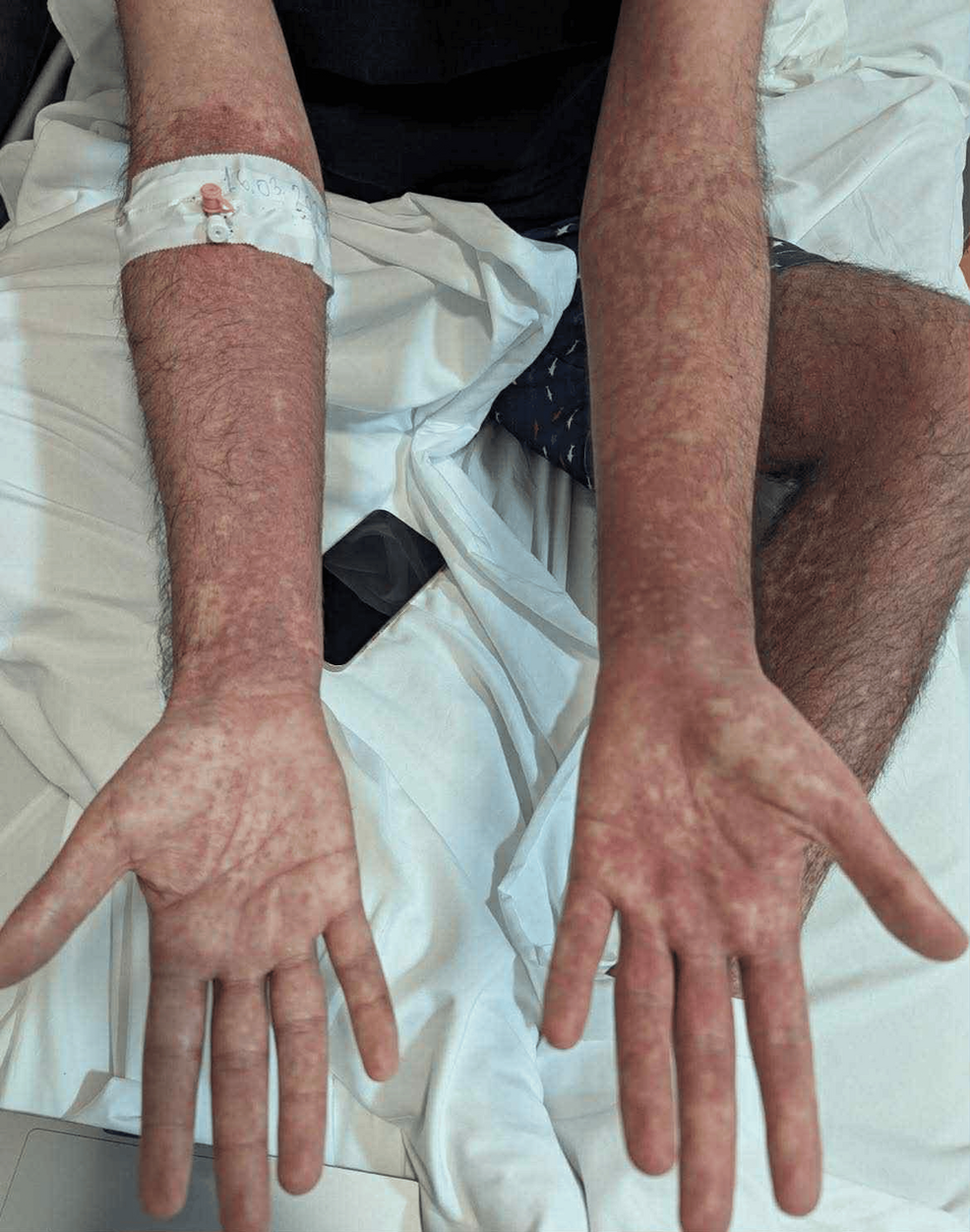 extreme mono rash PLEASE help : r/Mononucleosis, image size:986x1252