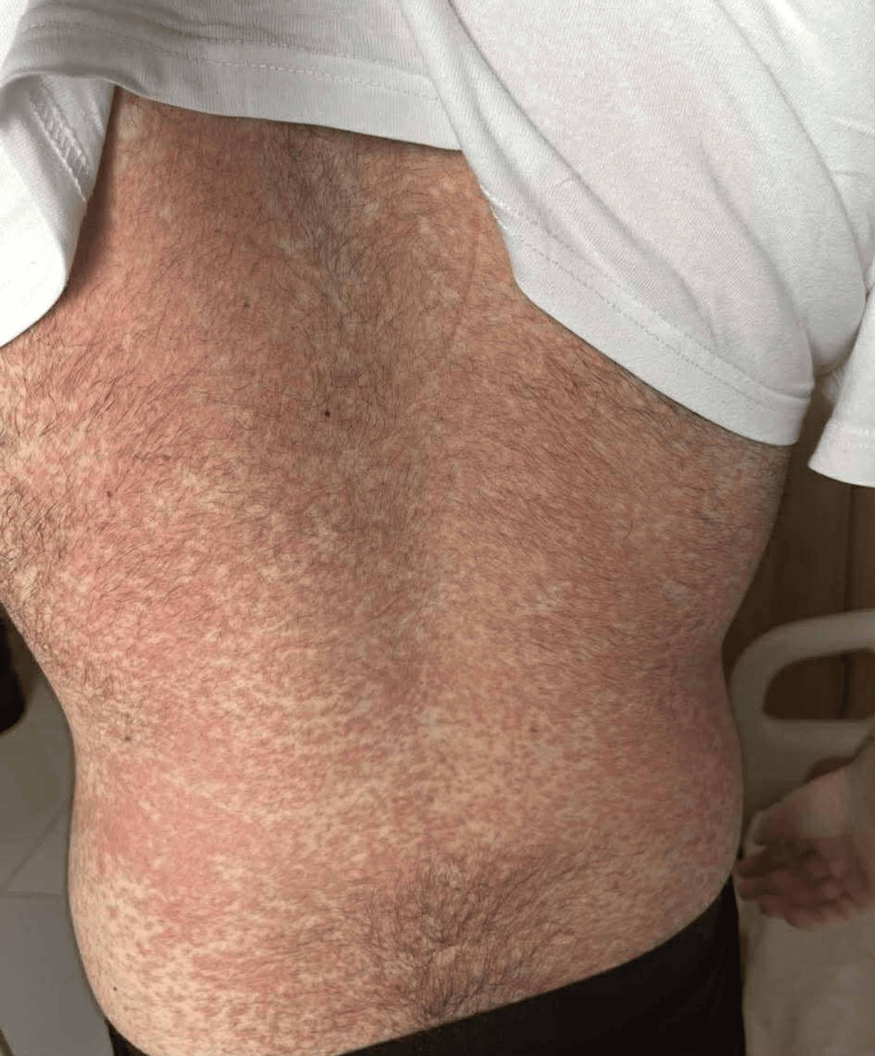 Symptoms of Mono Rash: Infectious Mononucleosis Causes, Treatment, image size:3000x3618