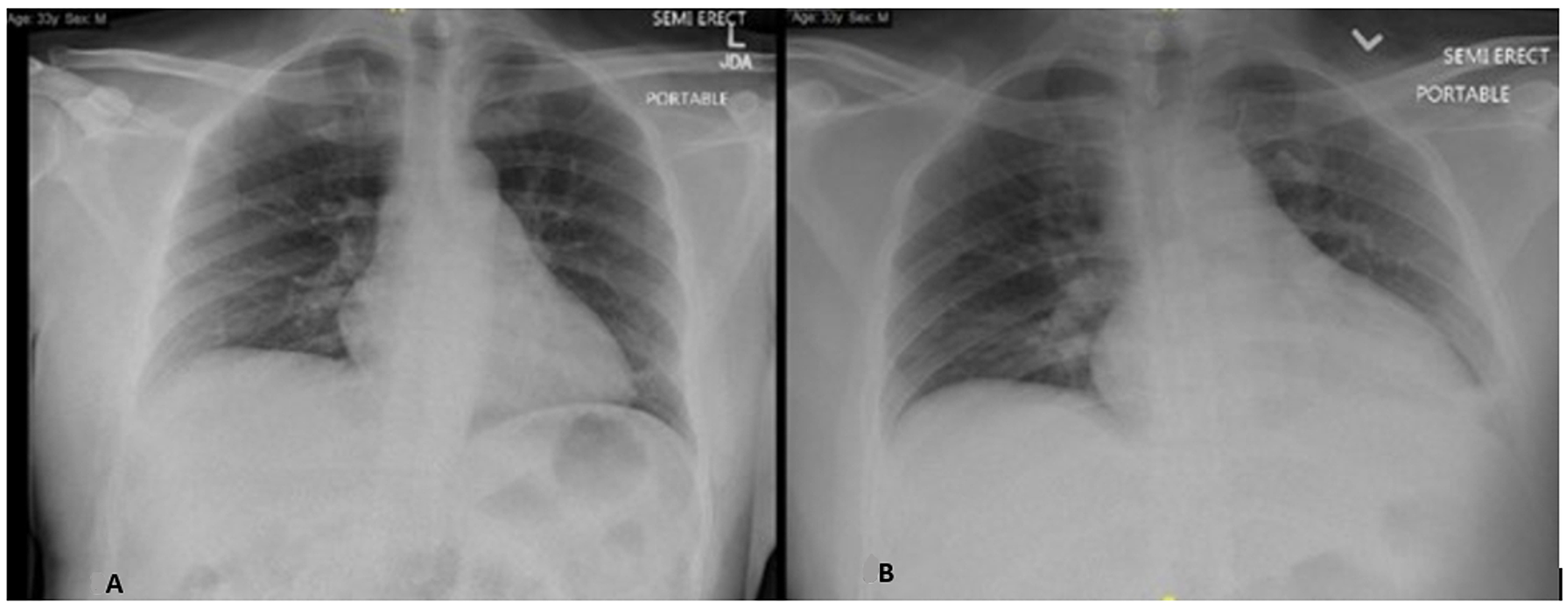 Cureus Myocarditis and Drug Rash With Eosinophilia and Systemic
