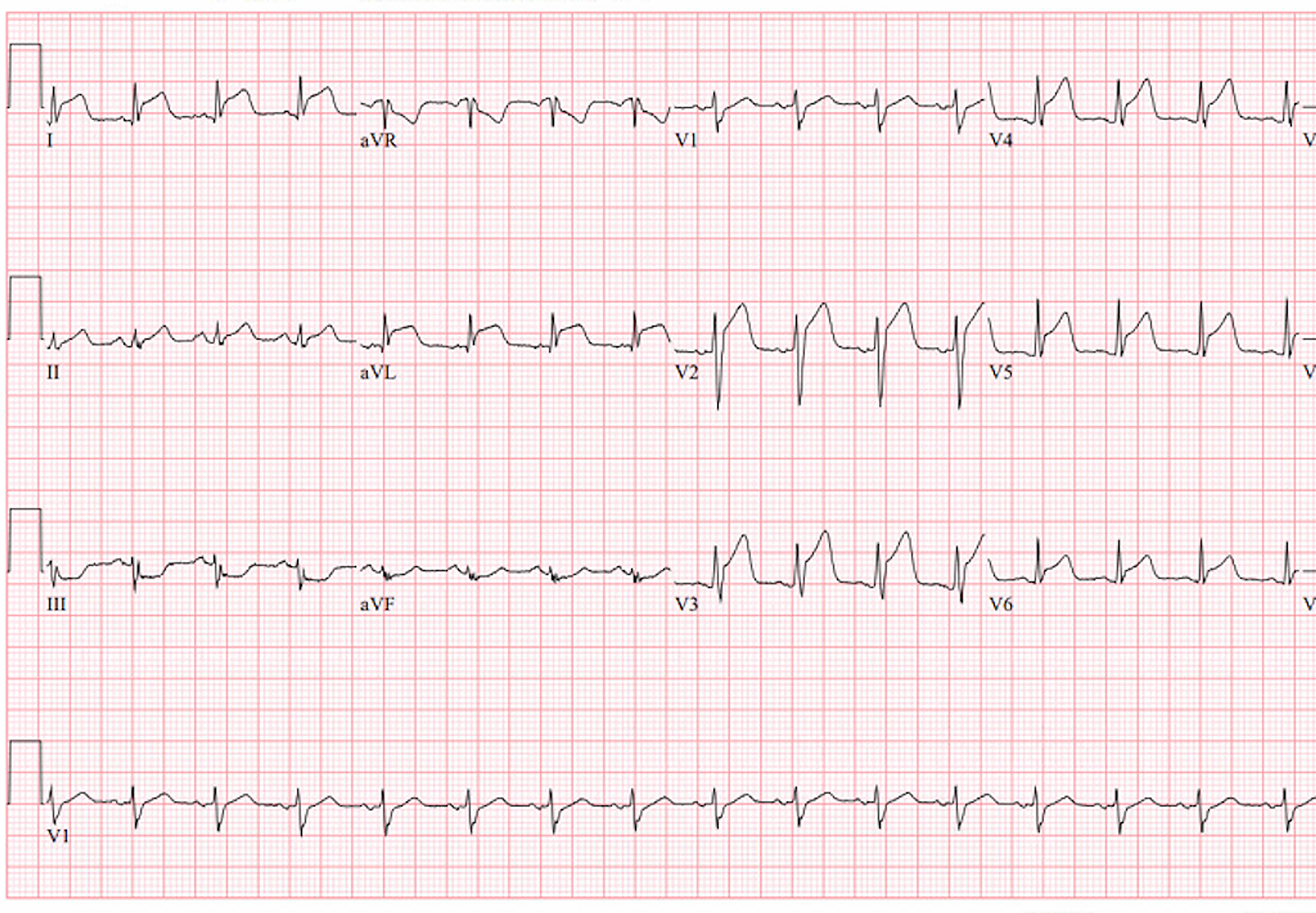 Cureus | A Rare Case of Myocarditis Mimicking ST-Elevation Myocardial ...