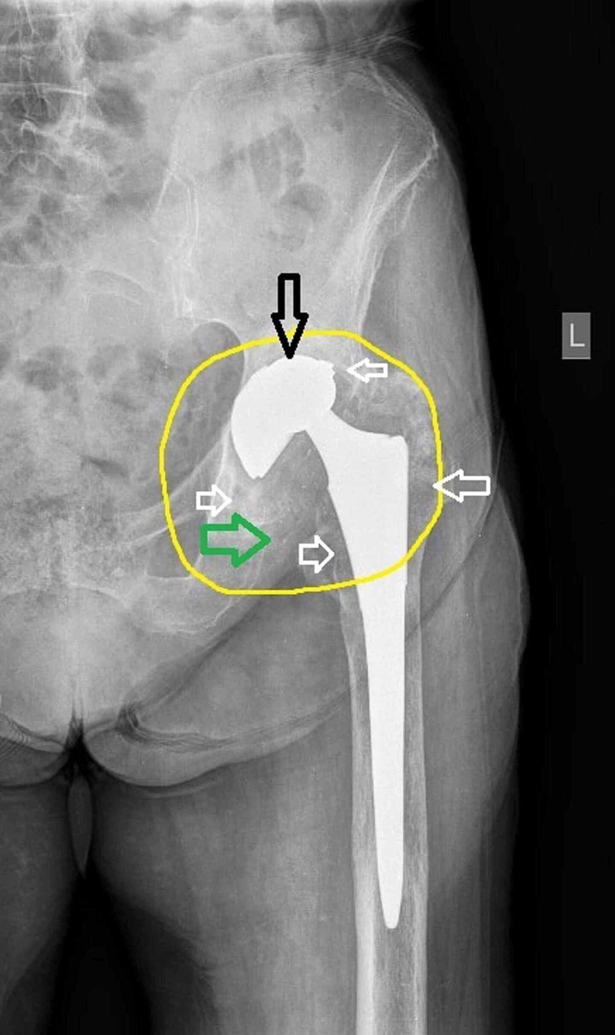 hip replacement xray