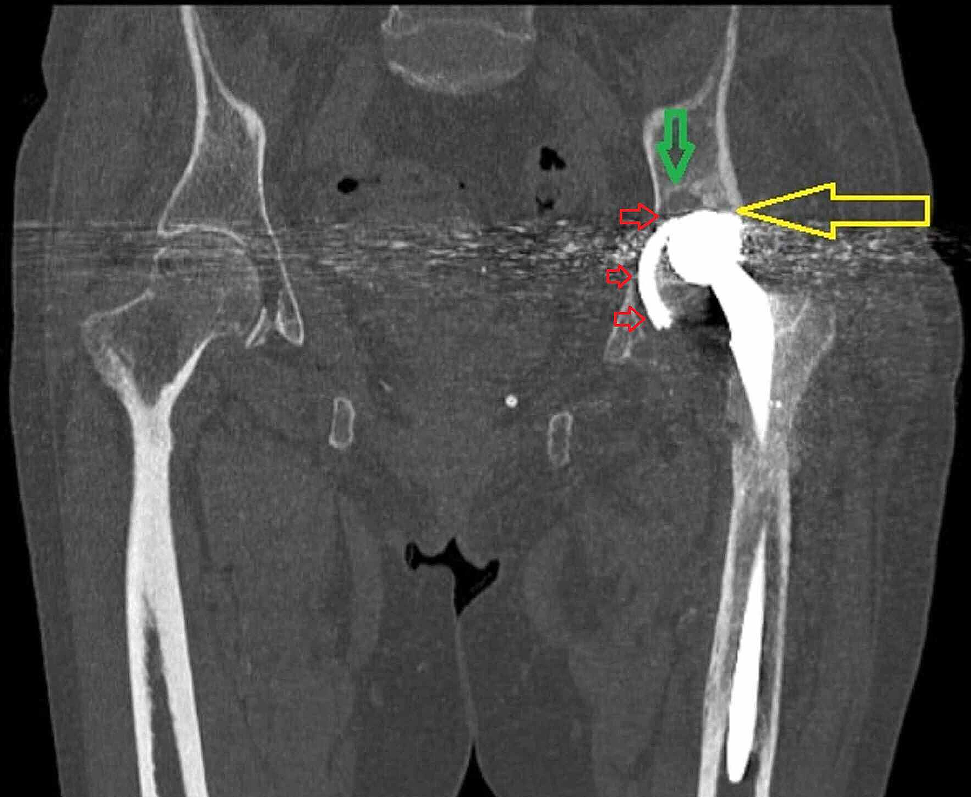 Cureus Catastrophic Wear Of An Acetabular Component Misdiagnosed As