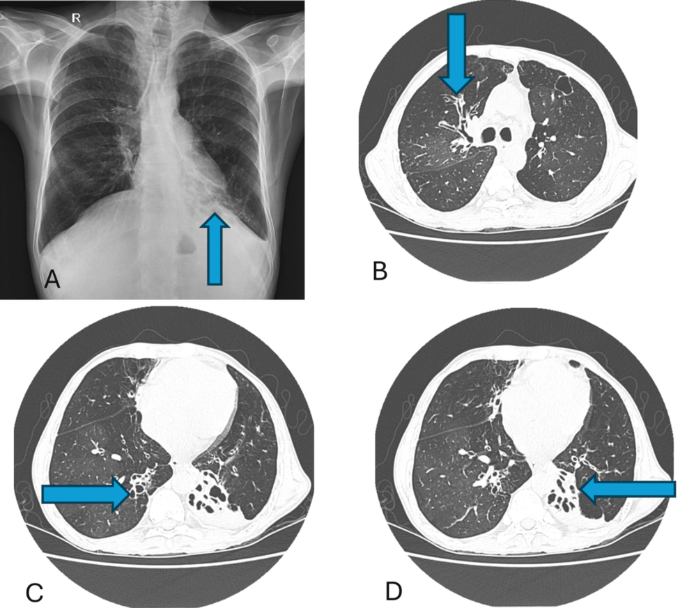 Beyond Post-tuberculosis Sequelae: Uncovering Common Variable Immunodeficiency in an Adult