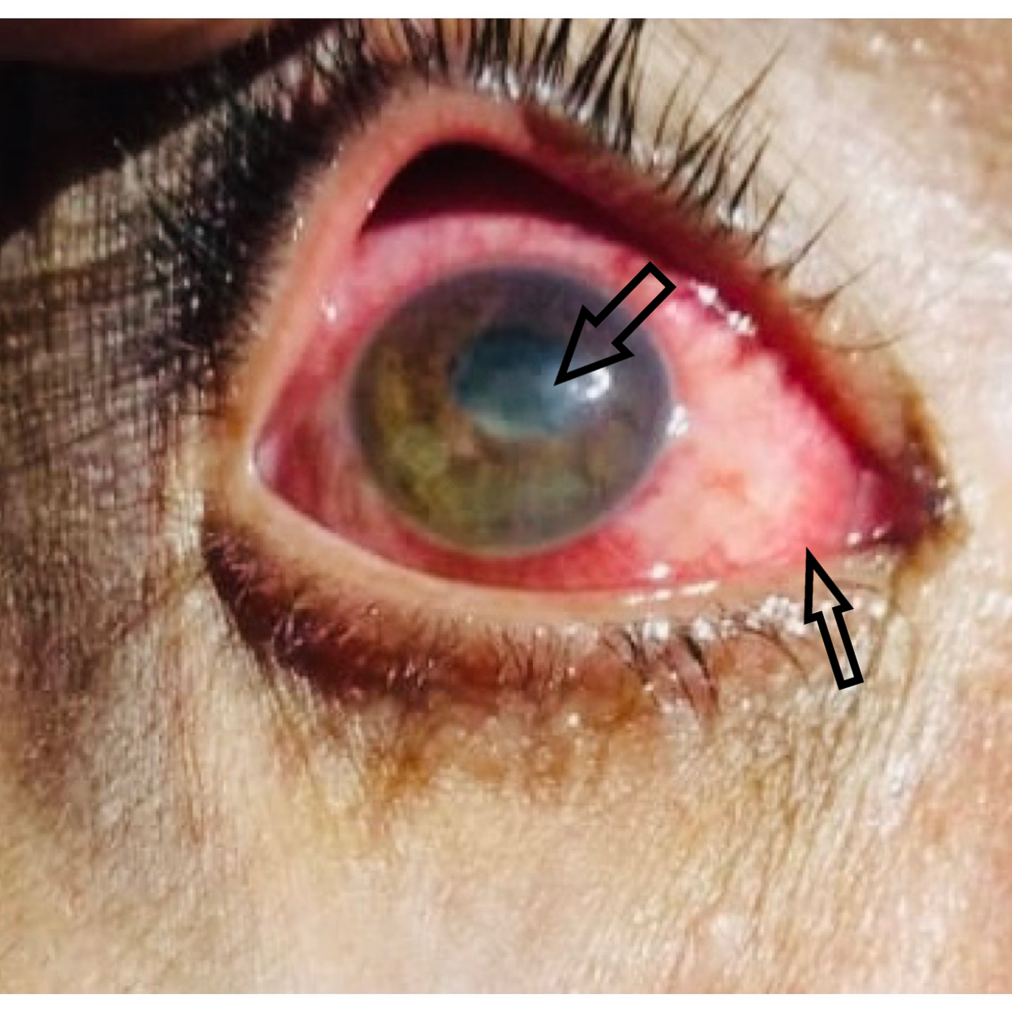 Cureus Navigating A Curious Case Of Unilateral Keratouveitis In Pakistan