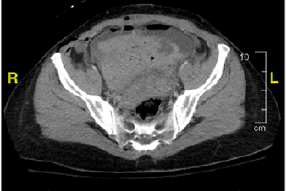 Cureus Cesarean Section Complications Followed by Bladder Cystotomy