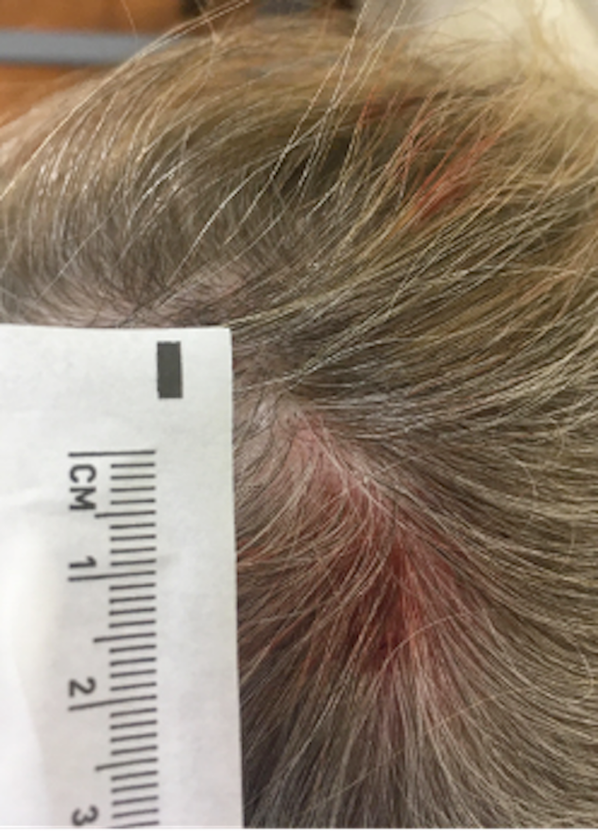 Cureus Ultrasound Detection Of Human Botfly Myiasis Of The Scalp A Case Report