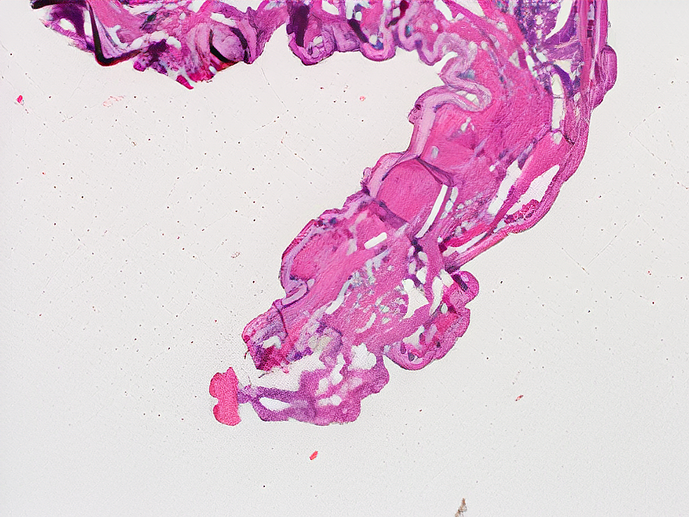 Ultrasound Detection Of Human Botfly Myiasis Of The Scalp A Case