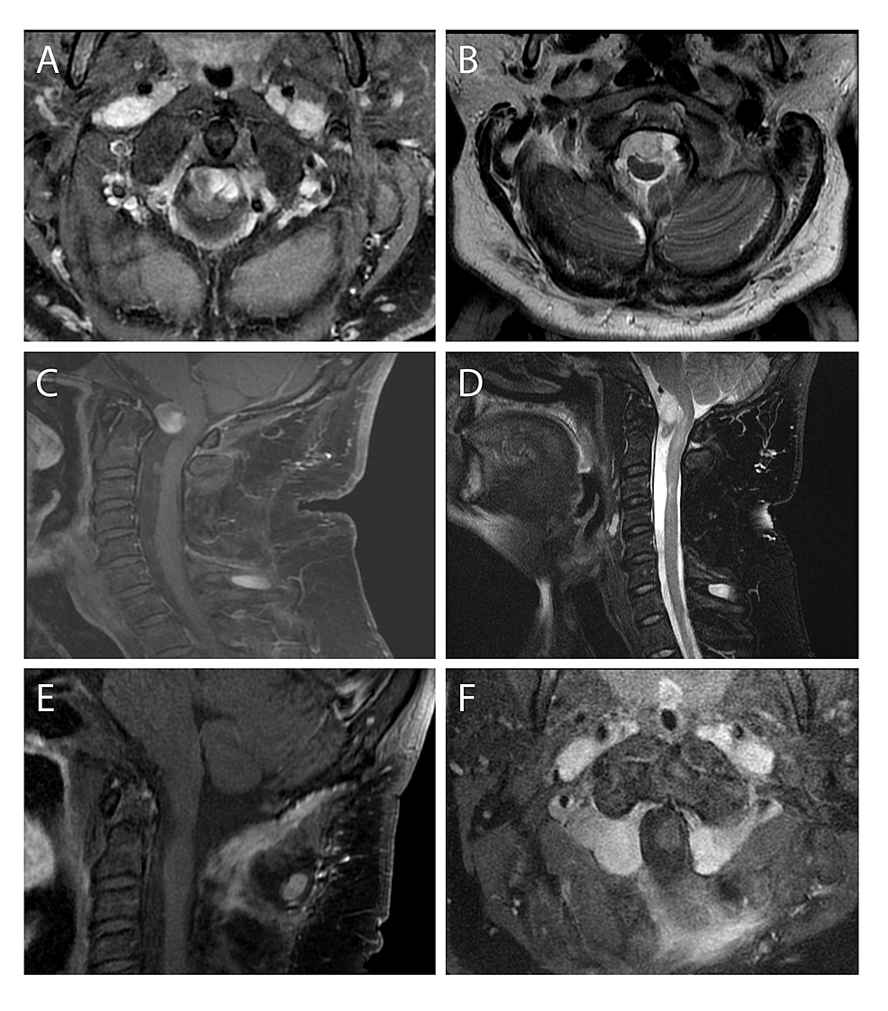 Cureus | Resection of Bilateral C1 Neurofibromas Using a Unilateral ...