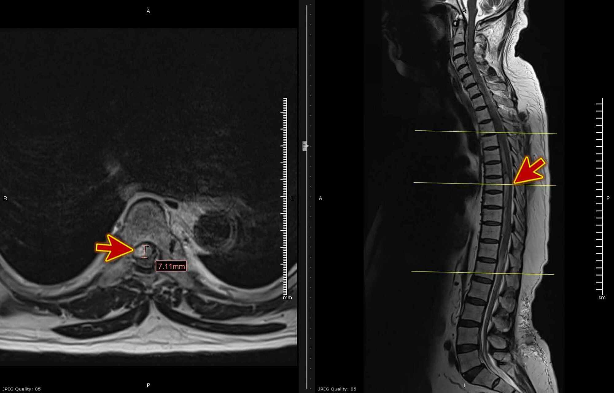 Cureus Acute Spinal Extradural Hematoma And Cord Compression Case Report And A Literature Review 7302