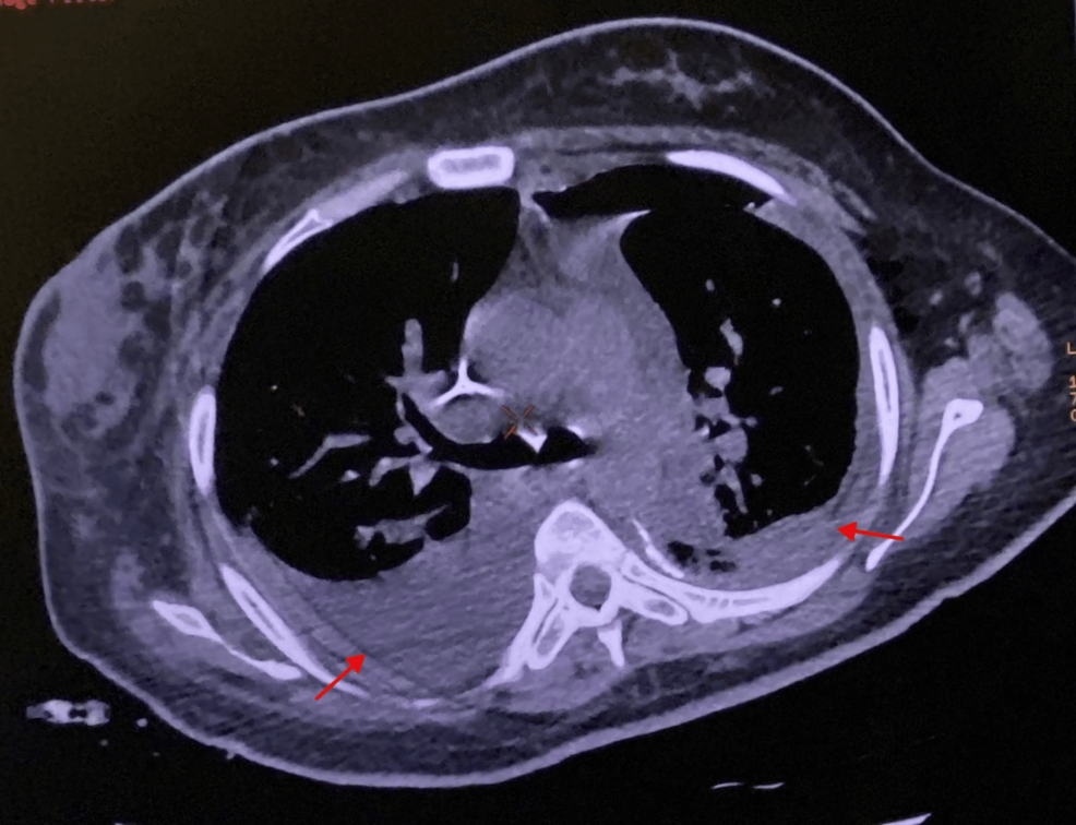 Co-infection avec Lophomonas spp. et Streptococcus pyogenes se présentant comme une pneumonie atypique chez un patient atteint de diabète sucré de type 1 mal contrôlé : un rapport de cas du Mexique
