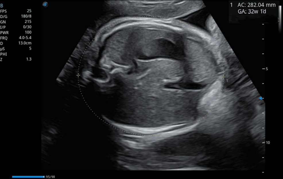 Gastric Adenocarcinoma in a Pregnant Woman at 33 Weeks of Gestation: A Case Report of Krukenberg Tumor Complicated by Uterine Rupture
