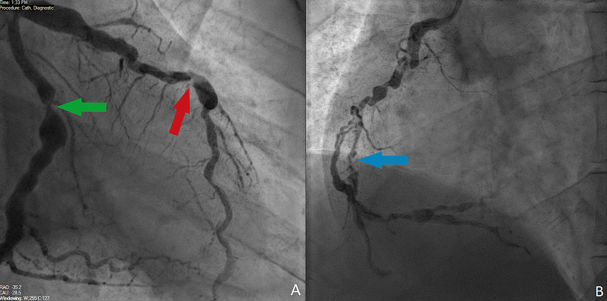 Cureus | Kawasaki Disease: An Unusual Case Of A Retrospective Diagnosis ...