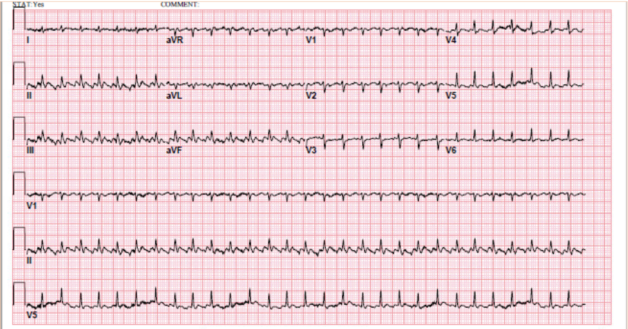 icd 10 code for atrial flutter