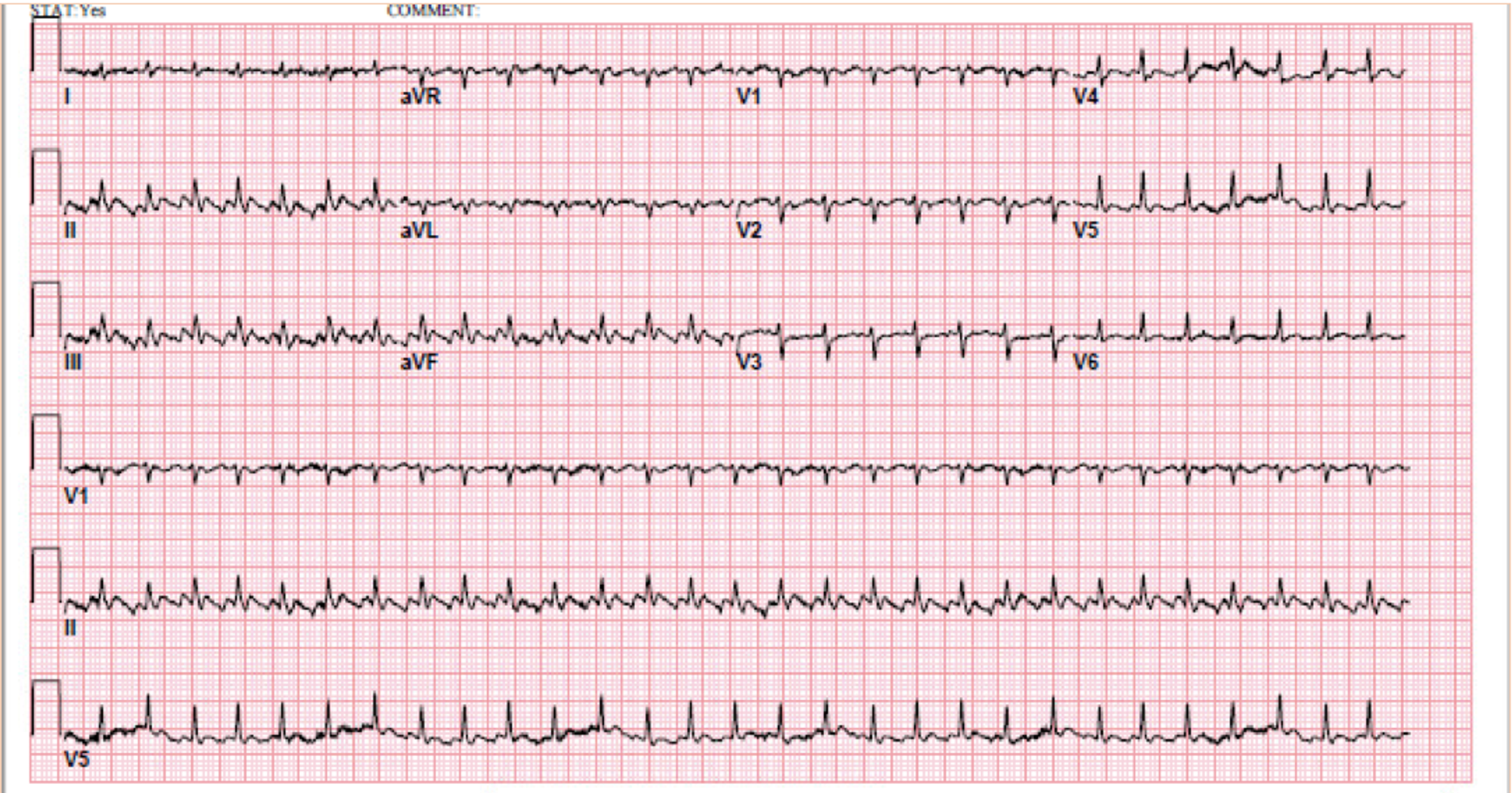 atrial flutter vs svt