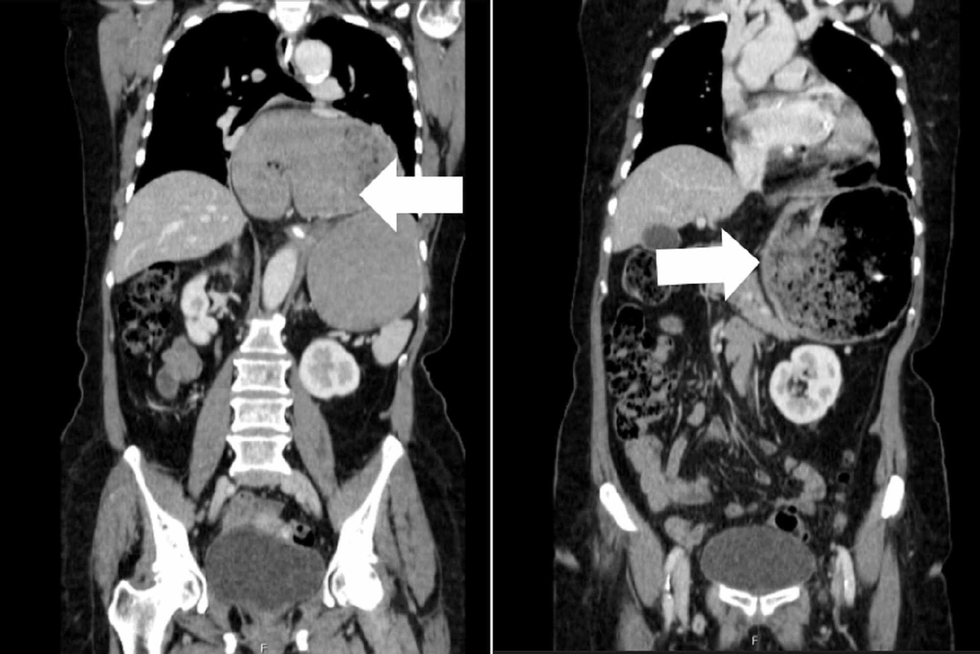 paraesophageal hernia with gastric volvulus