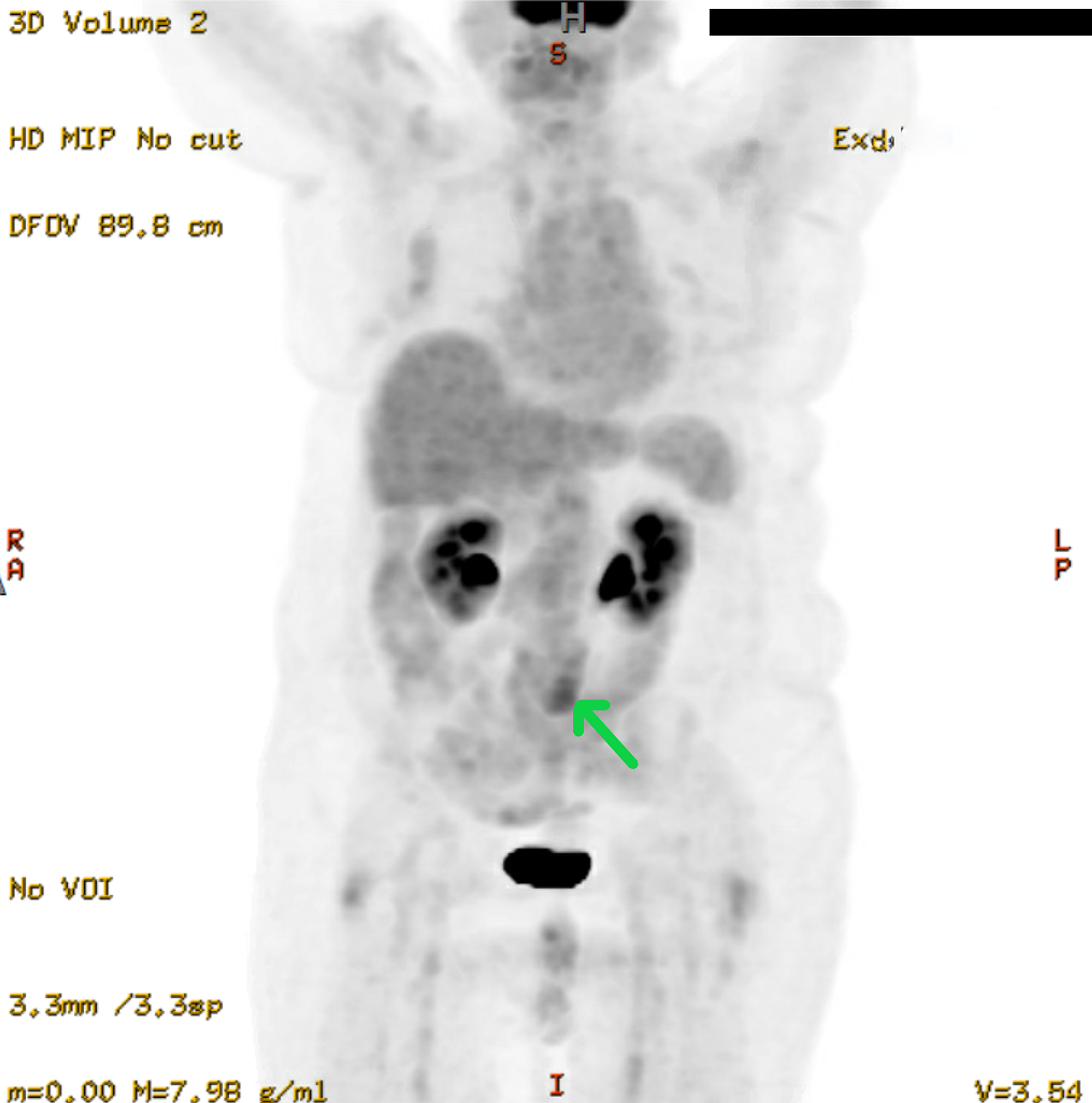 Cureus | Bilateral Hydronephrosis From Retroperitoneal Fibrosis