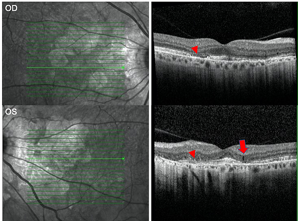 optical coherence tomography scan