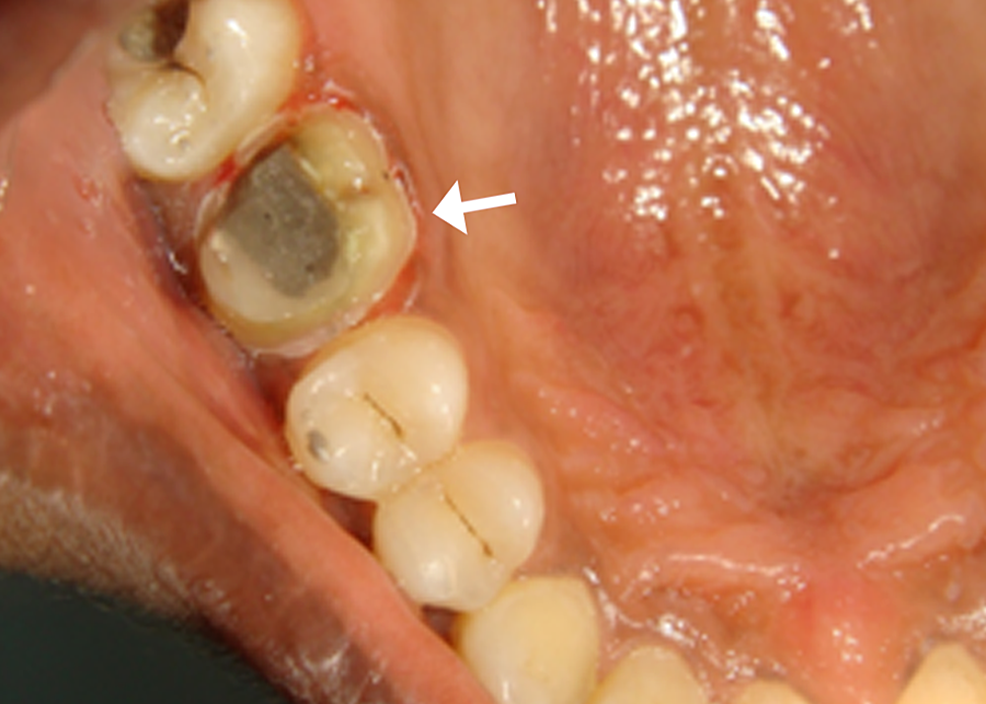Cureus Effect Of Different Crown Materials On The InterLeukin One Beta Content Of Gingival 
