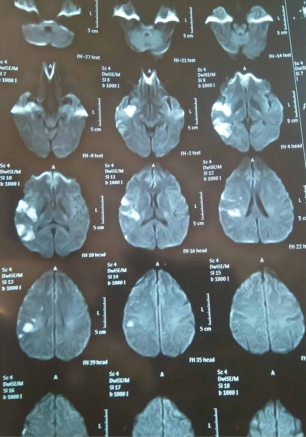 Cureus, Brainstem and Spinal Arachnoiditis Ossificans Associated With  Neurocysticercosis: A Case Report