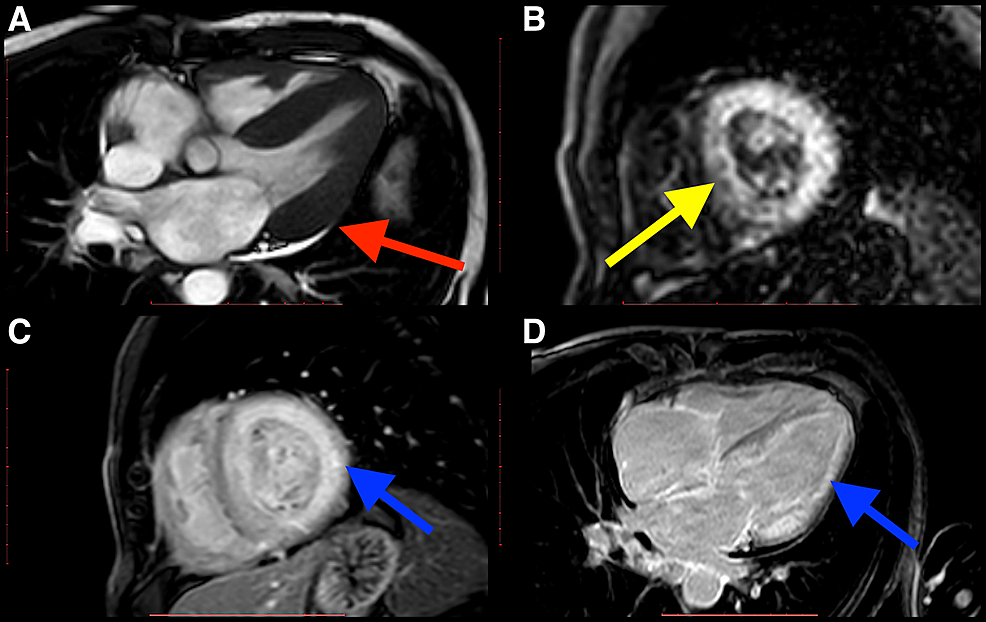 The uniqueness of cardiac magnetic resonance imaging in arrhythmogenic  right ventricular cardiomyopathy