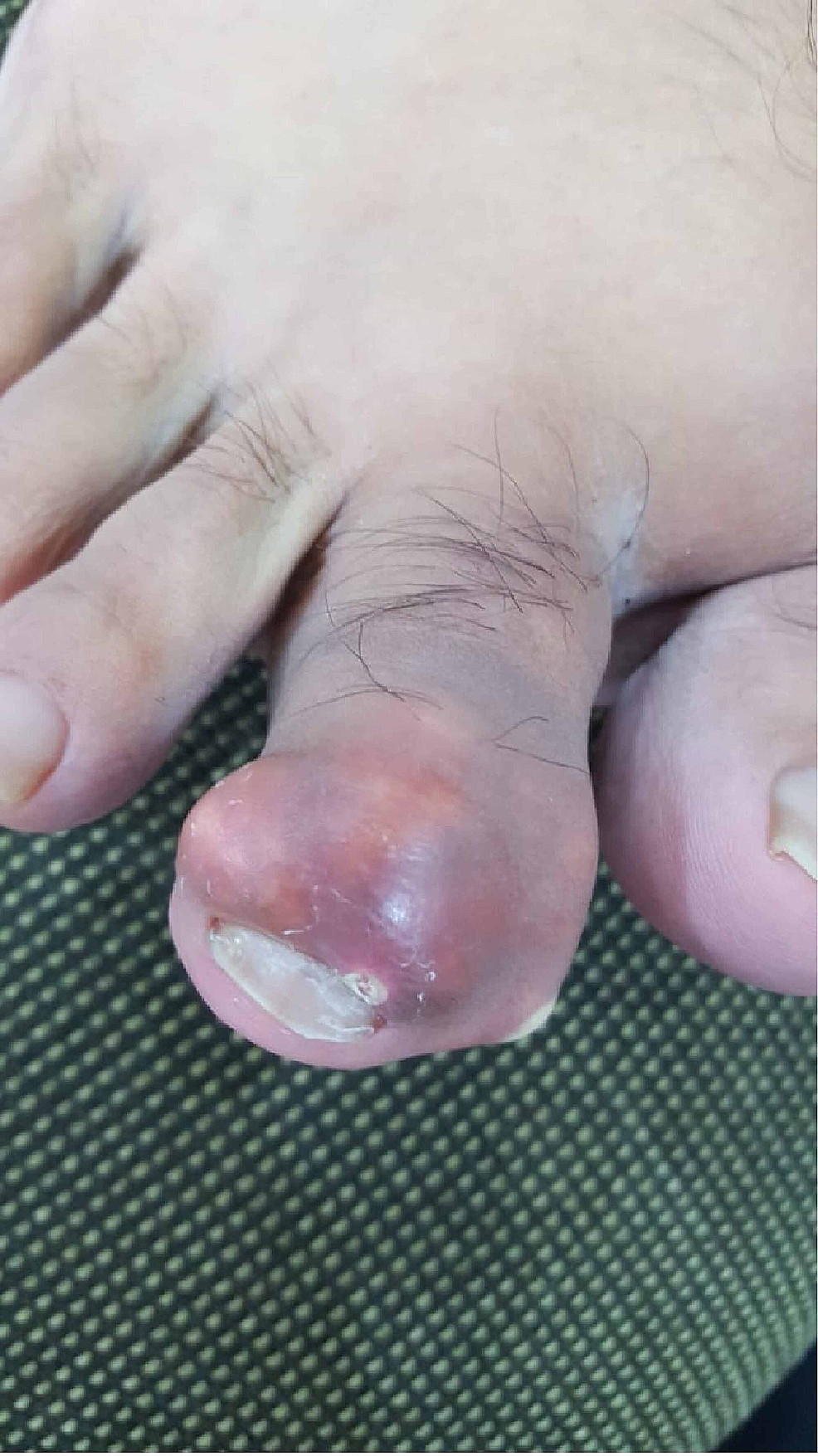 gout toe