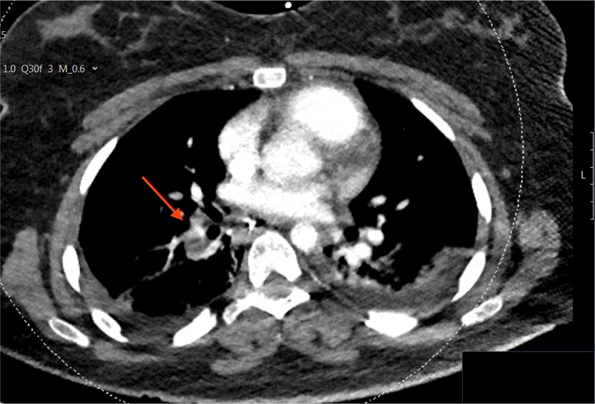 Cureus Massive Pulmonary Embolism As A Cause Of Cardiac Arrest Hot