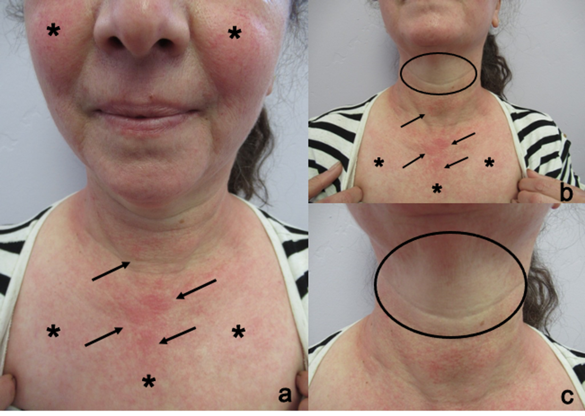 Cureus DoxycyclineAssociated Dual Cutaneous Adverse Reaction to the Drug (CARD) Case Report