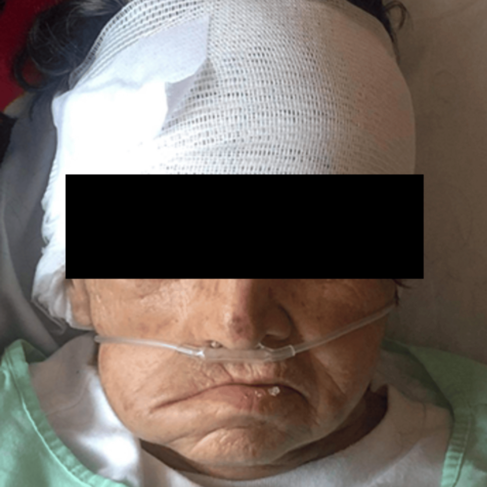 Jugulotympanic Glomus：血管中耳腫瘍のまれな症状に関する症例報告