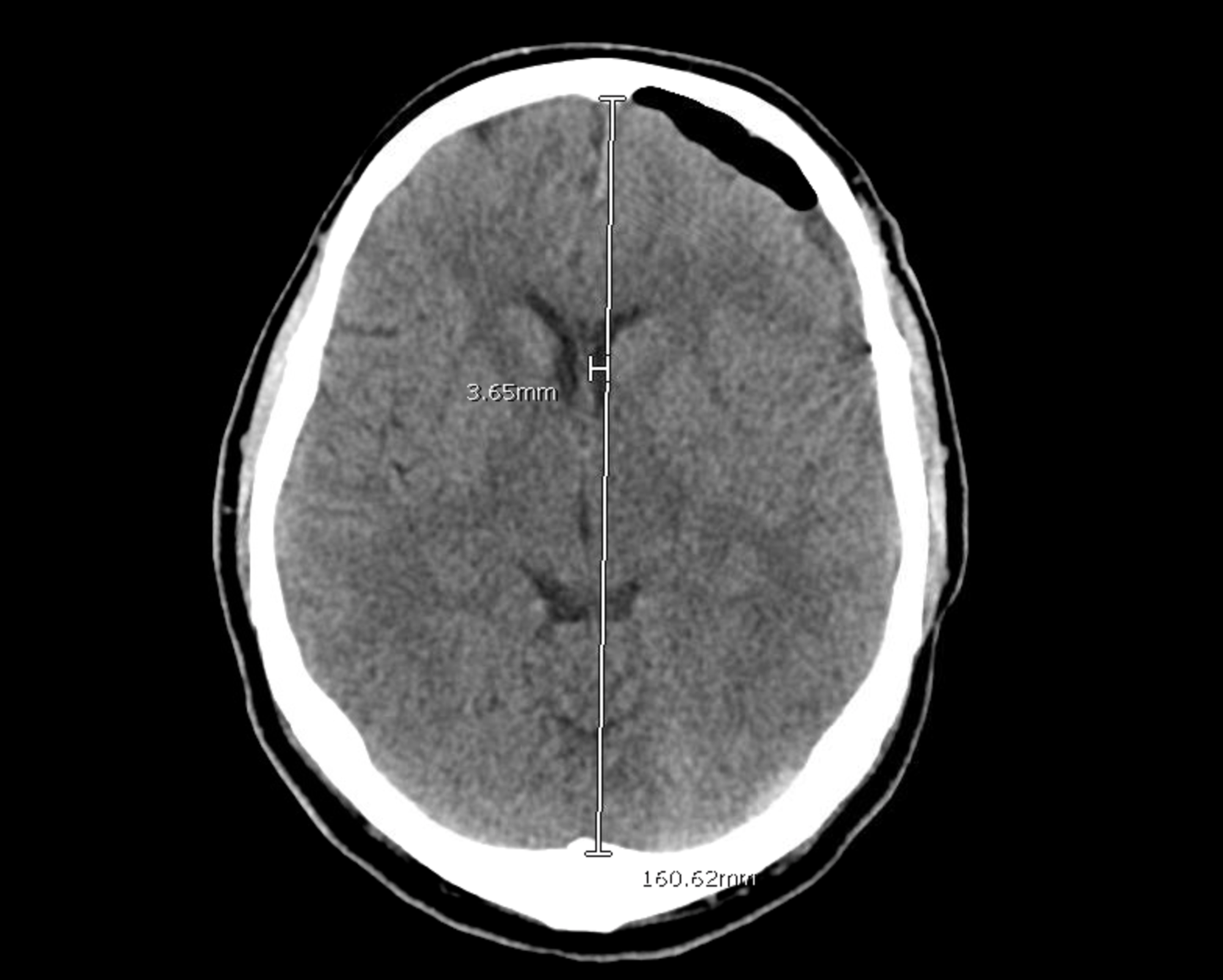 Minimally Invasive Approach To Subdural Hematoma Treatment Using Irraflow Catheter And Middle 9651