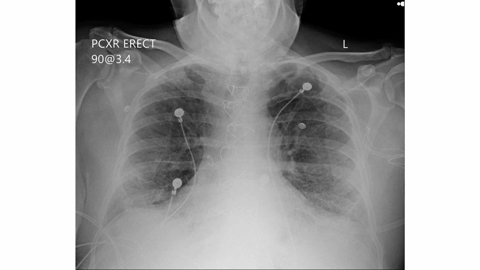 Cureus Treatment Experience With Inhaled Corticosteroids In Combination With Remdesivir And Dexamethasone Among Covid 19 Patients Admitted To A Rural Community Hospital A Case Series