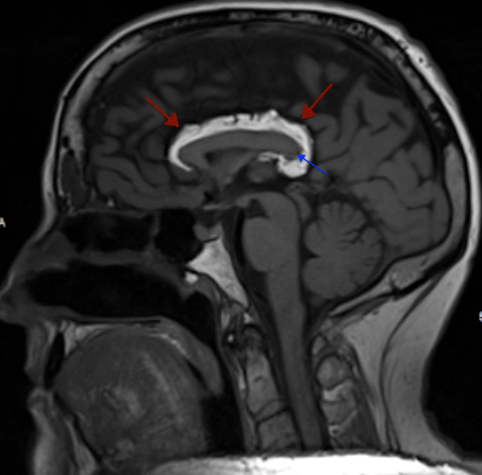 Cureus | Atypical Mixed Variant of Pericallosal Lipoma With Splenial ...