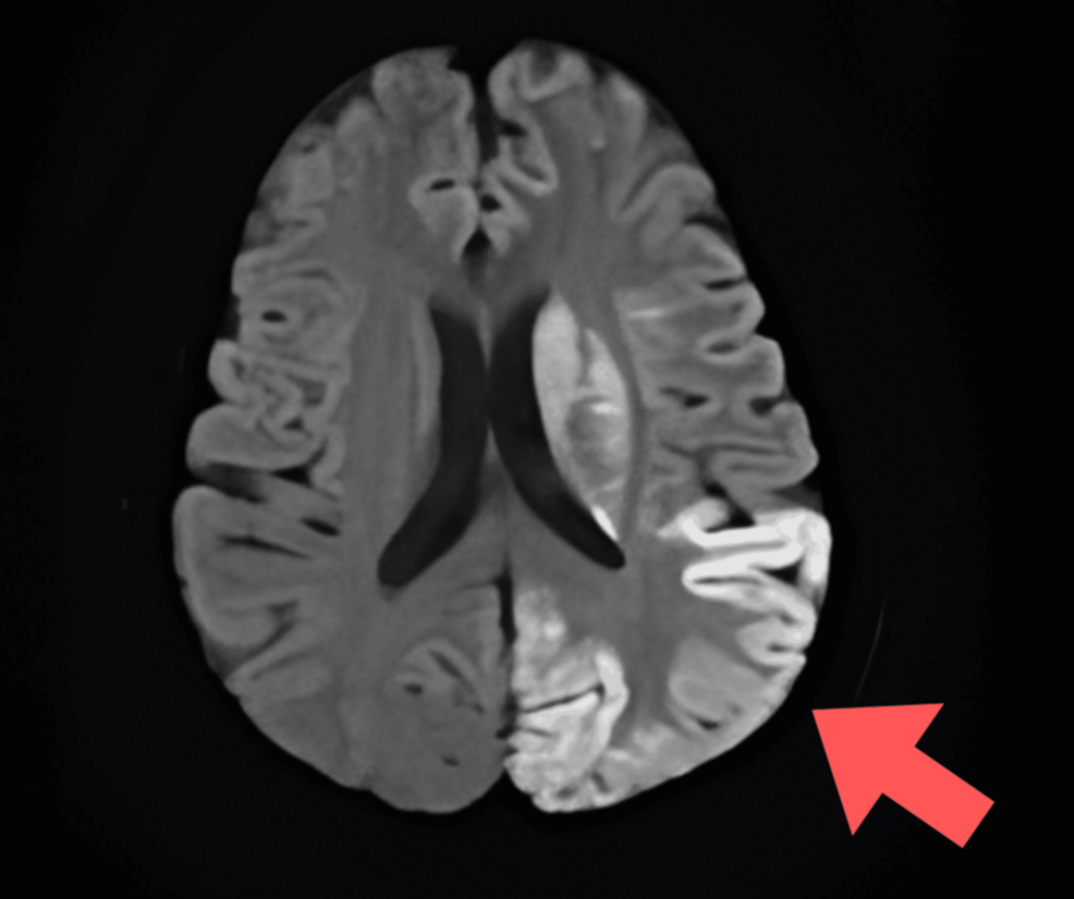 l carnitine seizures reddit Diagnosing Mitochondrial Encephalopathy, Lactic Acidosis, and Stroke-Like Episodes (MELAS) Syndrome in a Young Adult Female Patient With Seizures and Lactic Acidosis
