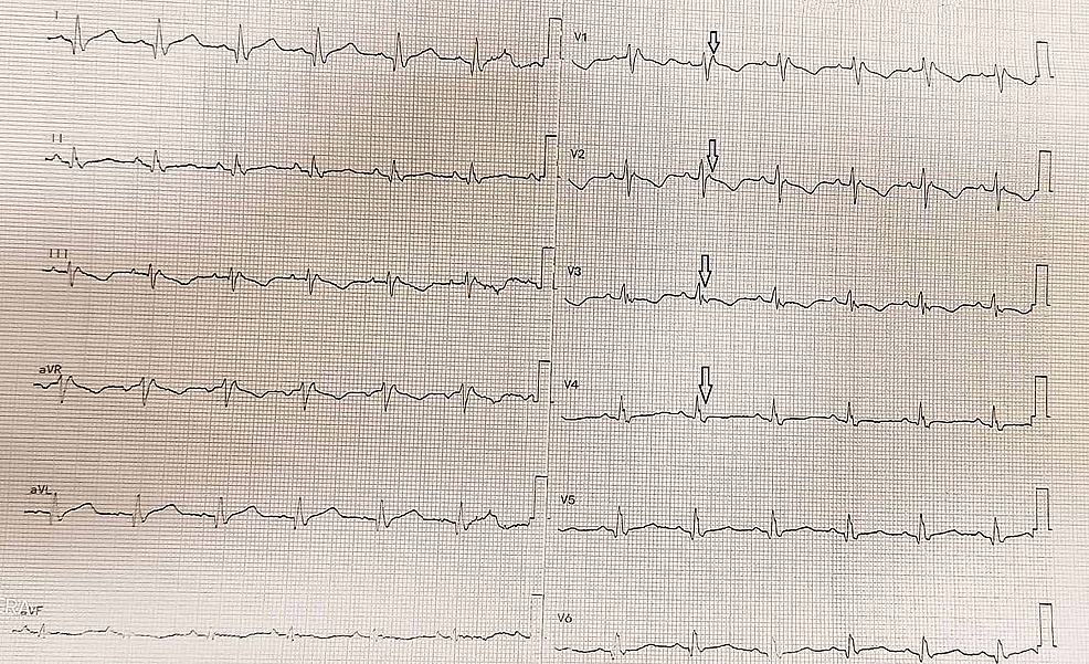 Left ventricular noncompaction—a rare cause of triad: heart failure,  ventricular arrhythmias, and systemic embolic events: a case report, Journal of Medical Case Reports