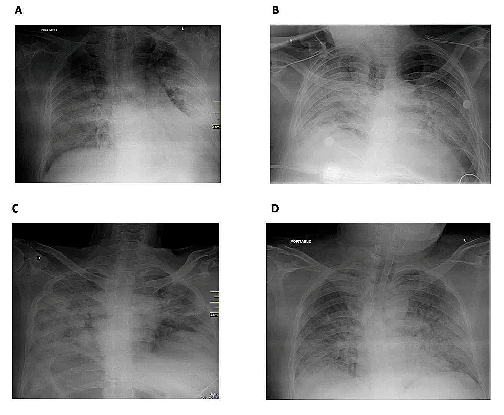 Clinical Characteristics of 47 Death Cases With COVID-19: A ...