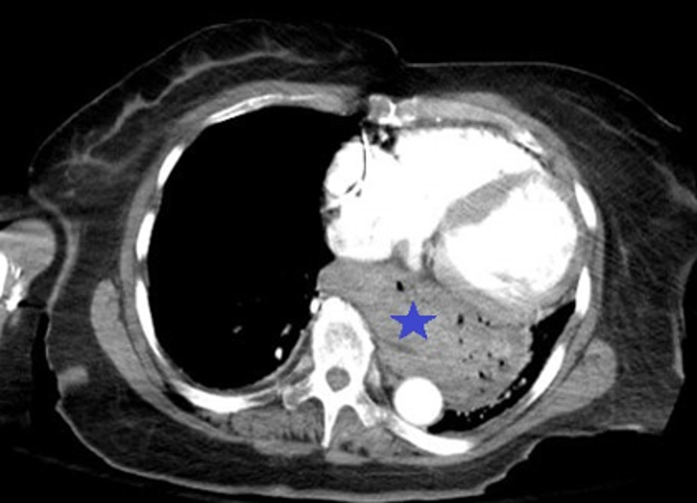 Hiatal Hernia Ct Scan Images Ct Scan Machine Images And Photos Finder   Article River 05ce7b00197811ebb6434d7f2a996a0e Webp.net Resizeimage 