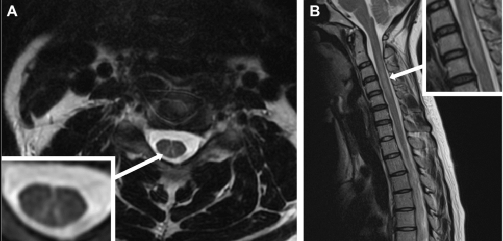 Typical-MRI-features-of-subacute-combined-degeneration-of-the-spinal-cord-associated-with-nitrous-oxide-misuse. Typical-MRI-features-of-subacute-combined-degeneration-of-the-spinal-cord-associated-with-nitrous-oxide-misuse.