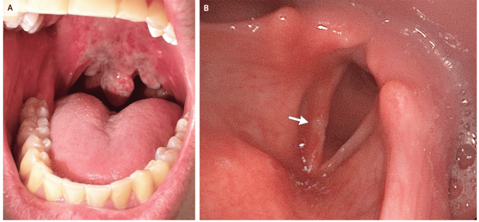 This-image-highlights-upper-airway-mucosal-injury-from-recreational-nitrous-oxide-use,-underscoring-the-importance-of-a-thorough-perioperative-airway-assessment. This-image-highlights-upper-airway-mucosal-injury-from-recreational-nitrous-oxide-use,-underscoring-the-importance-of-a-thorough-perioperative-airway-assessment.