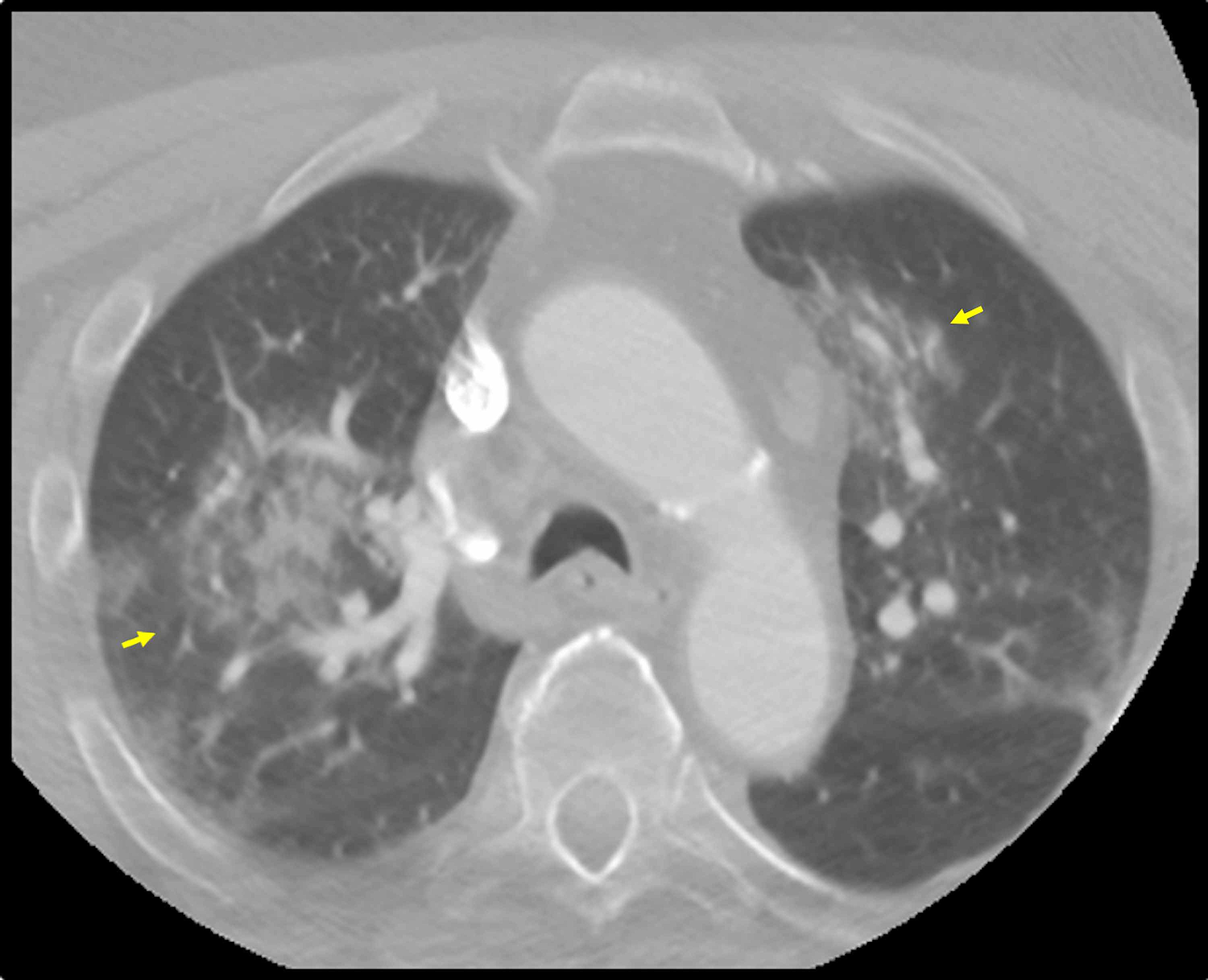 Cureus Early Diagnosis of COVID19 on NonChest CT Studies in the