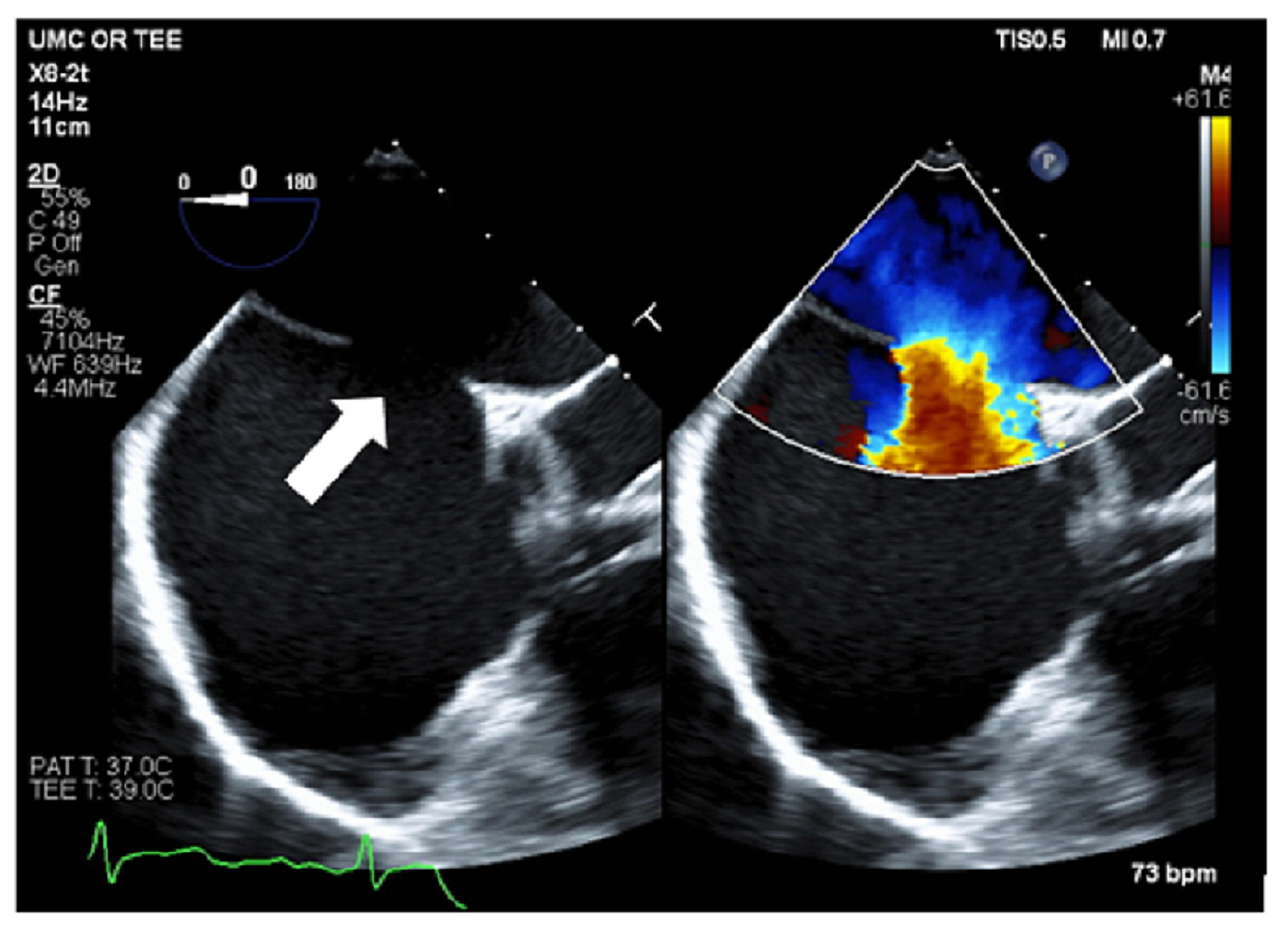 atrial septal defect ultrasound