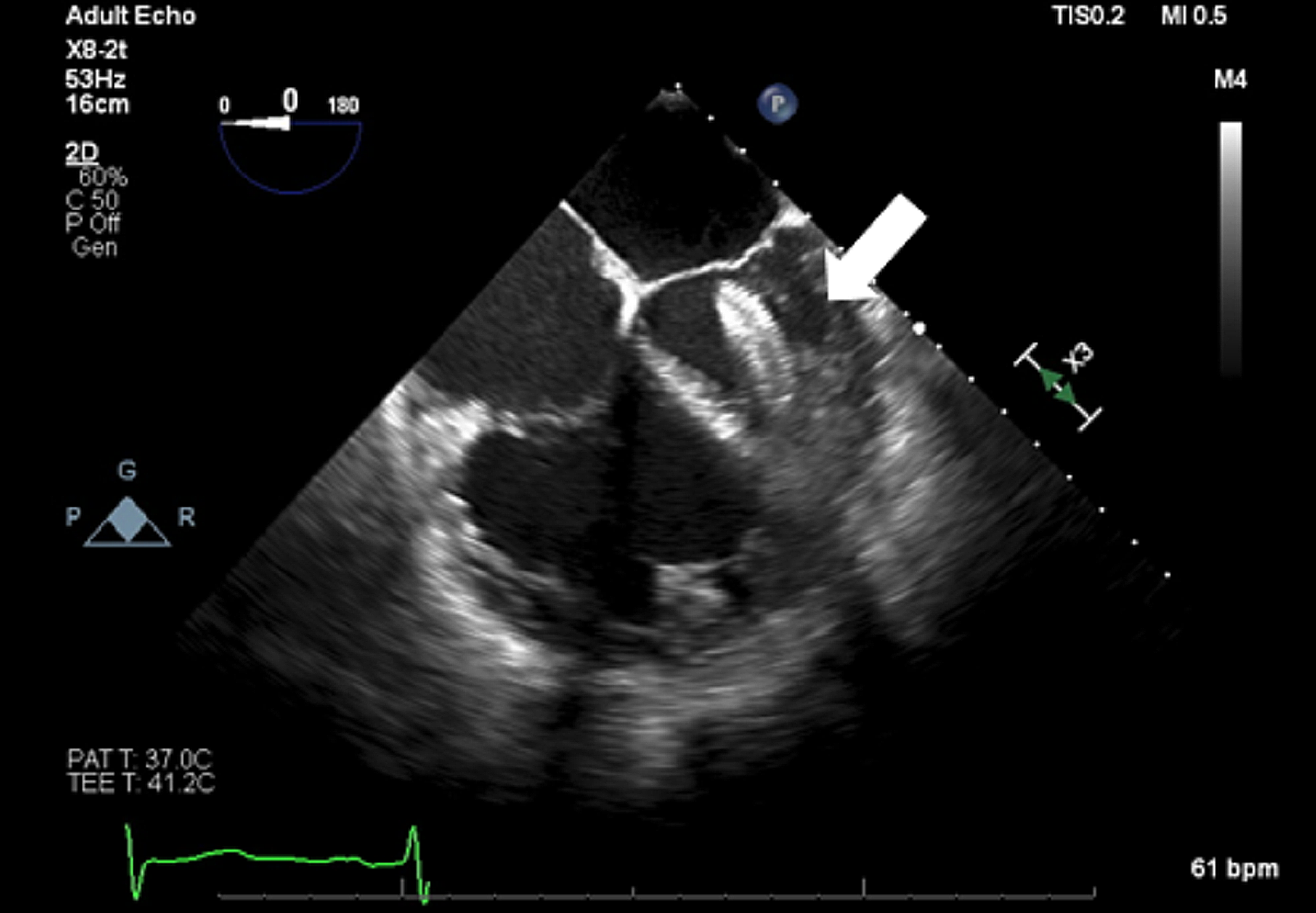 Cureus Embolization of an Atrial Septal Defect Occluder Device Into
