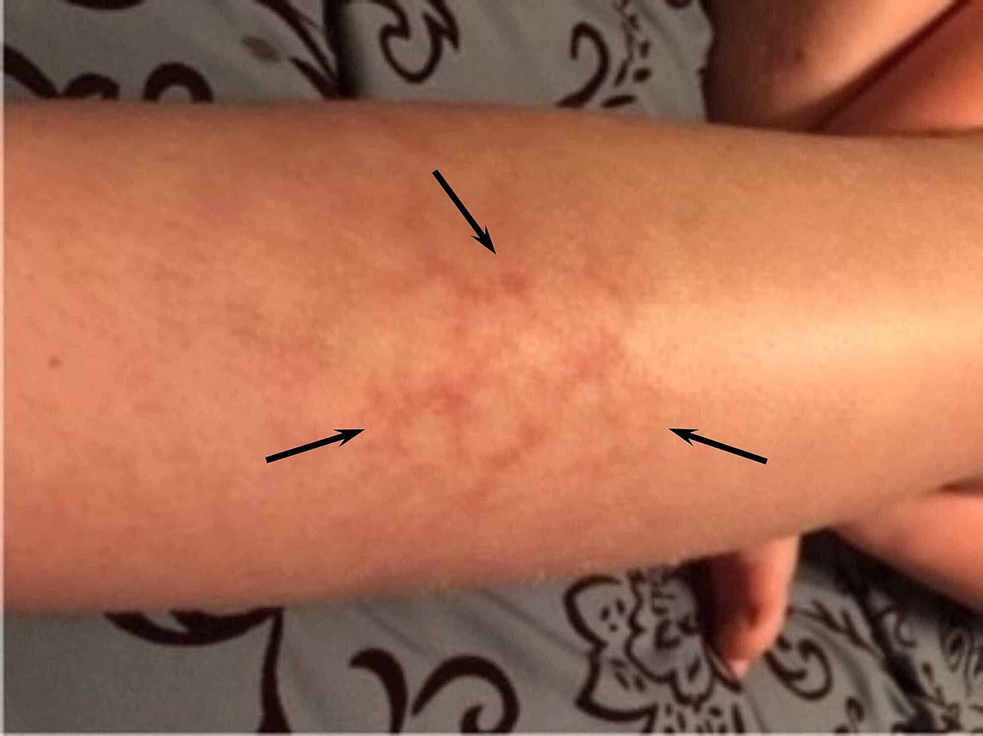 Cureus | Erythema Ab Igne in a 12-Year-Old Boy Diagnosed via Telemedicine
