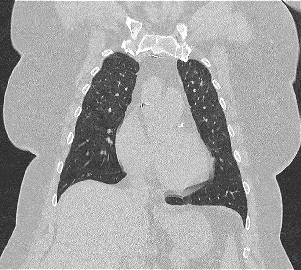 Cureus Hot Tub Lung A Diagnostic Challenge